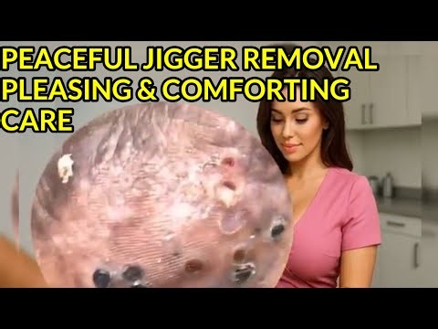 Peaceful Jigger Removal | Pleasing & Comforting Care