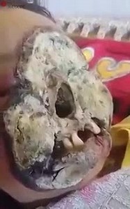 Vietnamese Girl’s Face Eaten Away by Disease