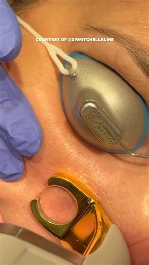 4.2K views · 4 comments | Are you constantly doing a double-take in the mirror because of those pesky nose veins? Well, worry no more! With ClearV, you can instantly zap them away. Best part? This treatment is suitable for all skin types. Plus, there’s no downtime! You can get back to your daily activities right after. How sweet is that? Take a look at these results by @drmitchellkline ⚡️ | Sciton, Inc. | Facebook