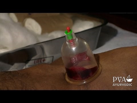 PVA: Hijama - Wet Cupping (Blood-letting) Ayurveda Therapy