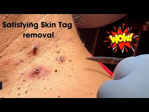 Amazing Satisfying Skin Tag Removal