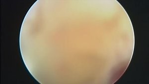 Arthroscopic HAGL Repair