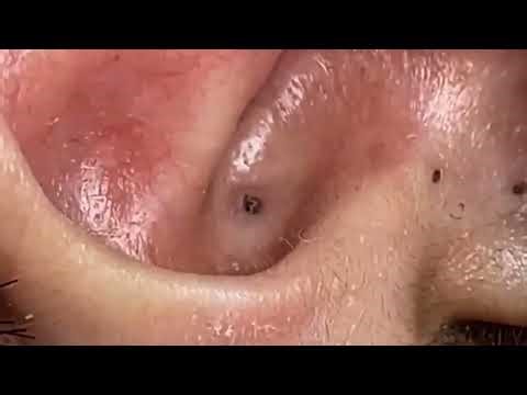 "Deep Ear Blackhead Extraction – So Satisfying!"