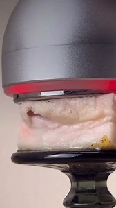 Thats how Ultrasound liposuction reduces the fat layer 🔥🔥🔥 | Diva Slimming and Aesthetics Center