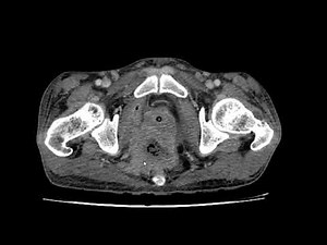 Perirectal and periprostatic abscess CECT