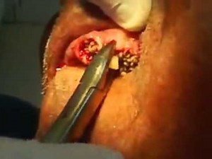 Maggots in gums