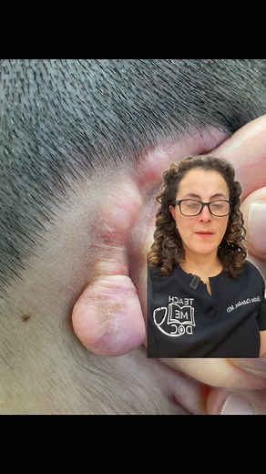 3.3K views · 24 reactions | KELOIDS vs HYPERTROPHIC Scars: One is...