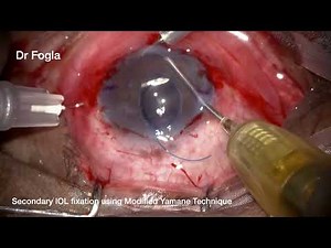 Secondary IOL fixation using modified Yamane Technique