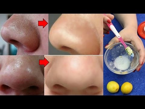 How To Remove Blackheads From Nose At Home - Whiteheads/Blackheads Removal