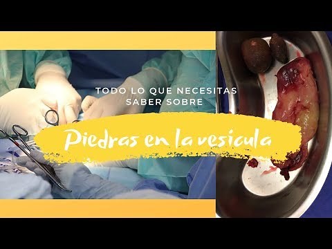 Piedras en la vesícula, causas, síntomas, etc | Todo lo que necesitas saber | Dr. Eduardo Jafet Ruiz