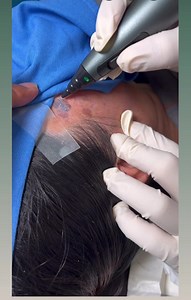 Cryotherapy for solar lentigines👍🏻 | Dr.Micky Hijam