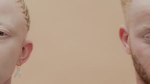 Albinism is a rare, non-contagious, genetically inherited difference present at birth. In almost all types of albinism, both parents must carry the gene for it to be passed on, even if they do not have albinism themselves. The condition is found in both sexes regardless of ethnicity and in all countries of the world. #InternationalAlbinismAwarenessDay | Department of Social Development | Facebook