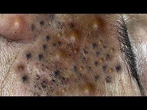 blackheads lipsl Acne treatment l Extraction cysts and blackheads l blackheads lips 100