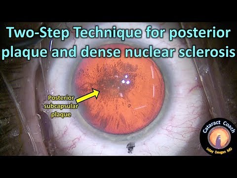 two step technique for cataract surgery with a posterior plaque and dense nucleus
