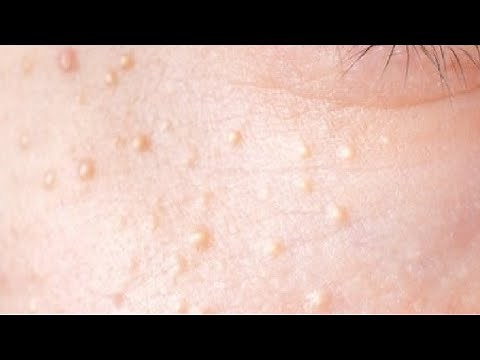 how to get rid of calcium deposits on face at home easy