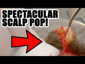 SPECTACULAR SCALP POP!