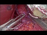 Adequate Heller Myotomy • Video • MEDtube.net