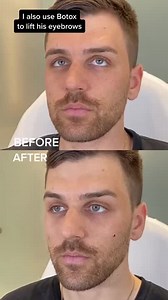 Male facial sculpting fillers white male temples cheek jawline chin