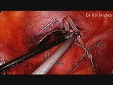 Laparoscopic Cervical Cerclage for Cervical Incompetence or Insufficiency • Video • MEDtube.net