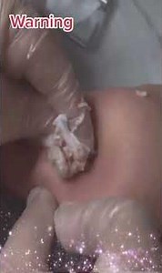 Pimple Popping & Blackheads 4K