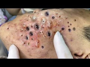 Blackhead Removal ASMR – Deep Pore Extraction Therapy for Stress Relief