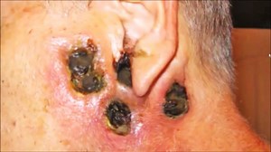 Blackhead King's Black Salve Case Study 👉 WATCH OTHER VIDEOS: 1. Viral Blackheads, Pimples, Senile Comedones & Whiteheads @ https://fb.com/2366549330255393 2. Blackheads - Satisfying Blackheads removal - Dr Pimple Popper @ https://fb.com/289445678599678 3. Pimple blackhead Inflamed Cystic Acne Removal | Part 1: On The Left Cheek @ https://fb.com/1266138523524962 4. BLACKHEADS REMOVAL on face | how to get rid of blackheads & whiteheads series acne treatment #020 @ https://fb.com/437544060139108 