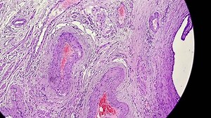 Hematosalpinx, is a condition where blood accumulates within the fallopian tubes, often associated with ectopic pregnancy, but can also be linked to endometriosis, PID or pelvic trauma