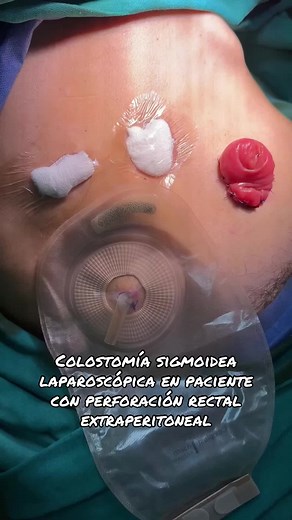 Colostomía en Asa: Proceso y Consideraciones Médicas