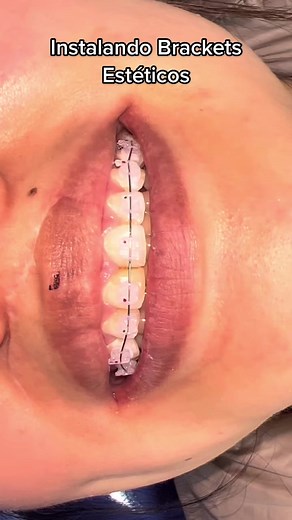 Aesthetic Bracket Installation in Dental Clinic