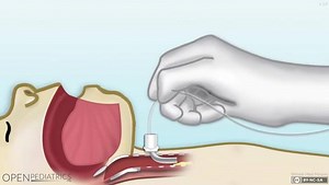 1.5K views · 33 reactions | Resource of the day: Check out our NEW animation showing how to suction a tracheostomy tube. Check out more helpful resources in the Library section of our website! https://www.openpediatrics.org/library | OPENPediatrics | Facebook