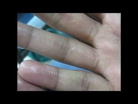 palmar hyperhidrosis treatment