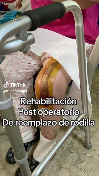 En este video te muestro el proceso de rehabilitación de una paciente que acudió a nosotros tras una cirugía de reemplazo total de rodilla. Antes de iniciar sus terapias, presentaba limitaciones en sus actividades diarias, como subir escaleras, desplazarse dentro de su hogar. Gracias al tratamiento, logramos mejorar su movilidad y ayudarla a retomar su vida con mayor seguridad y facilidad. 💪🏽✨ #Fisioterapia #Rehabilitación #ArtroplastiaDeRodilla #Movilidad #Salud #Fisioterapia #Rehabilitación 