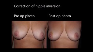 Inverted nipple correction