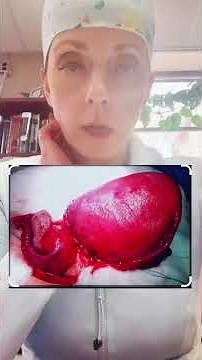 What is a uterine didelphys?