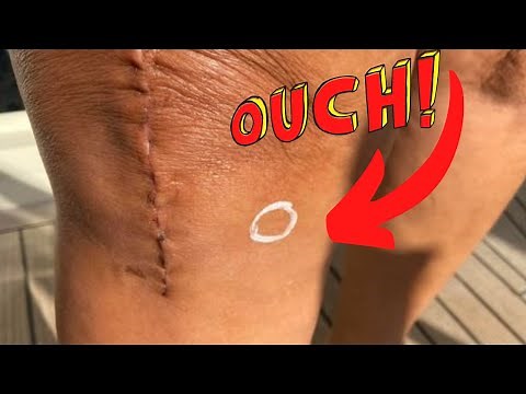 Pain on the Inside Edge of Knee After Total Knee Replacement