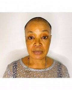 The Thread Lift procedure gives you a younger, more natural-looking appearance. It is one of our anti-aging procedures that is tailored to the needs of the individual. The Thread lift is beneficial to both men and women who want to reduce the appearance of wrinkles and jowls on their faces. This procedure can also help to reduce the appearance of sagging skin by gently pulling it tighter, giving you a firmer, younger appearance. It provides immediate results without the downtime or scarring asso