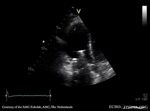 File:Starr-Edwards prosthesis of mitral valve E00908 (CardioNetworks ECHOpedia).webm - Wikimedia Commons