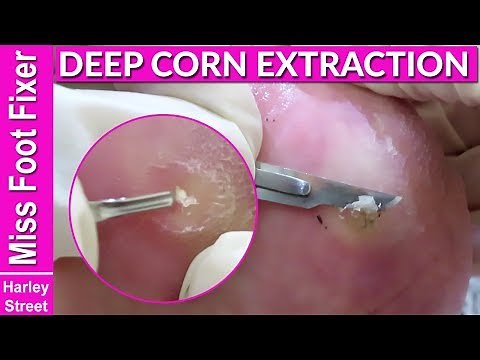 SATISFYING DEEP CORN EXTRACTION AND REMOVAL BY MISS FOOT FIXER
