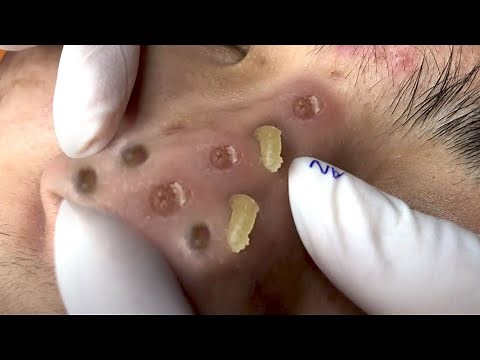 Clean Giant Blackheads on Nose