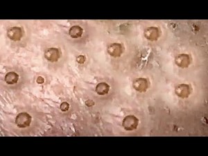 Amazing Blackheads Remover on the Face #004
