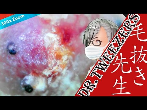 272 [200x Zoom] Have you seen the details of scabs? Dr. tweezers 毛抜き先生の角栓や毛根