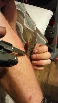 Gnarly road rash scab removal