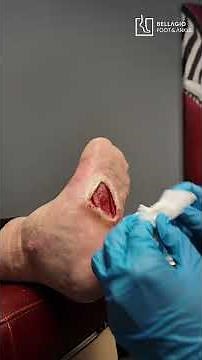 Charcot Rocker Bottom & Plantar Ulcers: Expert Foot & Ankle Care Explained