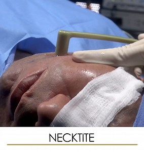  : NeckTite: The process of combining radiofrequency energy with...