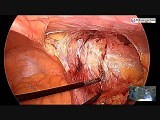 Easiest Way of Performing Laparoscopic Inguinal Hernia Repair Using Less Expensive Mesh • Video • MEDtube.net