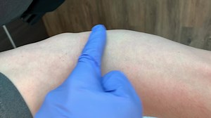 Le signe du ”Lacertus notch” peut souvent être vu chez les patients souffrant du syndrome du lacertus. Une expansion fibreuse émergeant du tendon du biceps et se prolongeant vers la face interne du coude, peut être responsable d’une pression excessive sur le nerf médian. Elle peut laisser une empreinte et causer une déformation à la face interne de l’avant-bras ou du coude. The ”lacertus notch” can sometimes be seen in patients with lacertus syndrome. The tight lacertus expansion coming off the 
