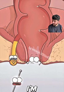 A fistula is an abnormal tunnel that forms between two parts of the body, often developing as a result of inflammation, infection, surgery or conditions such as Crohn’s disease. ⁣ ⁣ They can cause symptoms like pain, irritation and recurrent infection. Treatment varies from person to person but may include medication, drainage procedures or surgery to remove the fistula and help the area heal properly. Thankfully I have never had one. This video gives a simple visual explanation of how a fistula