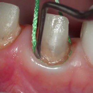 1.5K views · 64 reactions | Inserting Retraction Cord Credit @dr.uchiyama #Dentistry #Clinical | Bites & Braces Dental | Facebook