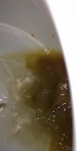 Laxative diarrhea - video 6