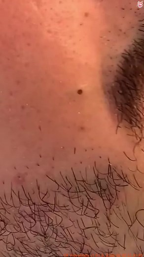 #pimples_brufoli_ #pimples #brufoli #blackhead #fyp #acne #popping #zit #pimplepop #pimple #foryou #pimples_brufoli #longervideos# (8346)
